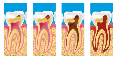 soin des caries cannes