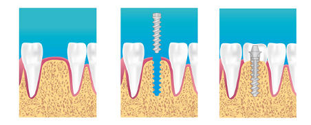 Implant dentaire Cannes Implant dentaire Cannes 06